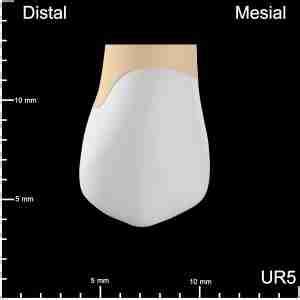 Ur Mesial Occlusal And Distal Decay K Teeth