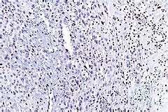 Epithelioid sarcoma - Libre Pathology