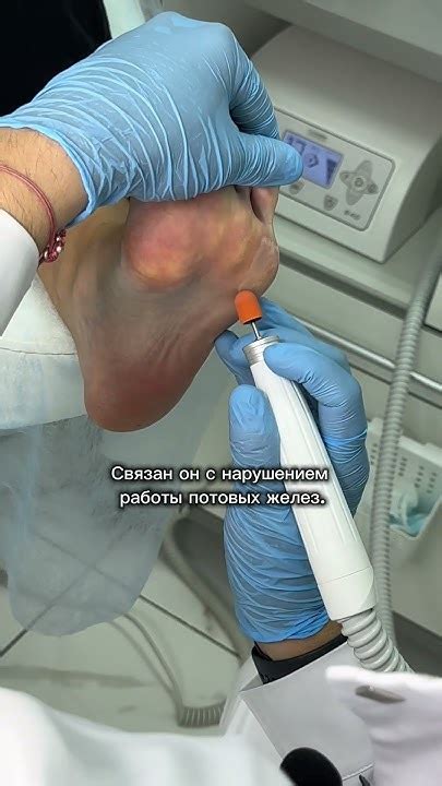 Лечим гипергидроз ️ Больше о здоровье ногтей и стоп у нас на канале ...