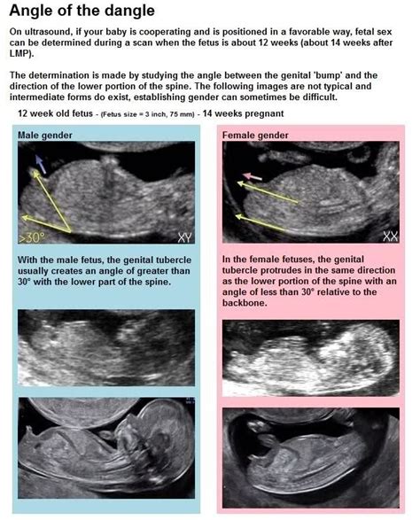 Week Ultrasound Gender