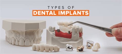 Your Guide for Dental Implant Types and Procedure - Clove Dental