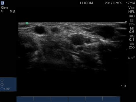 IMSK Upper Extremity Ultrasound Right Cubital Fossa Diagram Quizlet