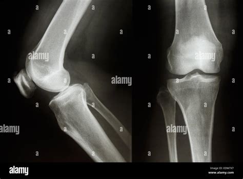 Film X Ray Montrent L Articulation Du Genou Normal Ap Lat Ral Photo