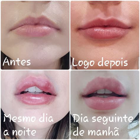 Labio Roxo O Que Fazer LIBRAIN