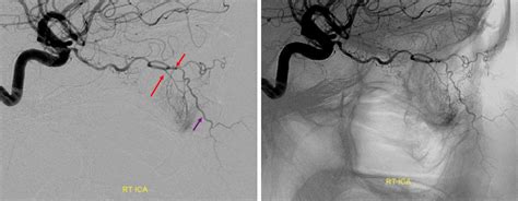 Sphenopalatine Artery Neuroangio Org