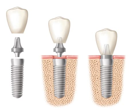 What Are Dental Implants Abutments And Crowns Aaid American