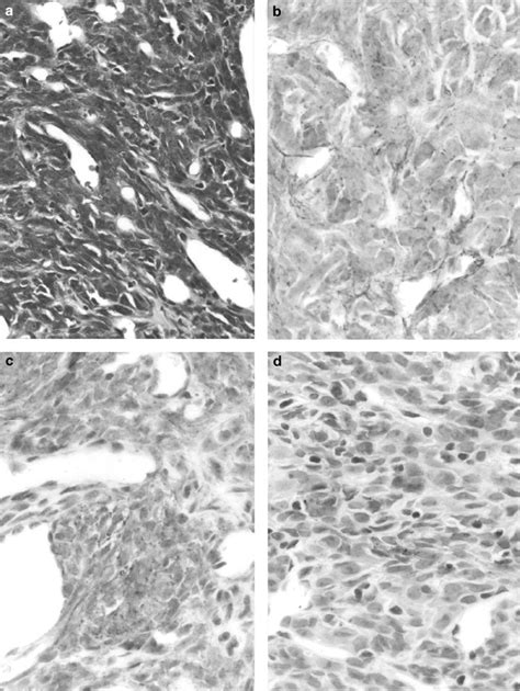 Aberrant Expression Of Tight Junction Related Proteins Zo 1 Claudin 1