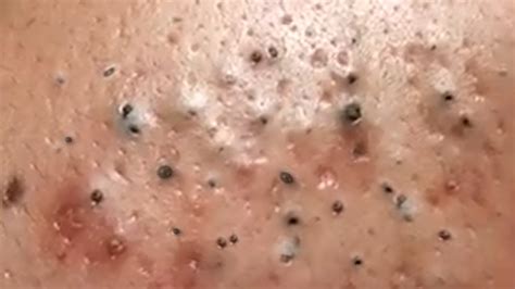 Blackhead Extractions Blackheads Removal Acne Treatment Big