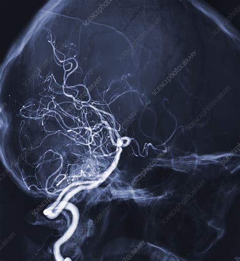 Cerebral Arteries Angiogram Stock Image F037 7063 Science Photo Library