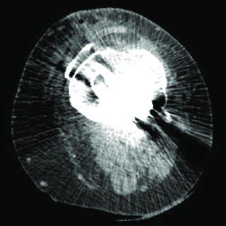 Axial Ct Angiogram At The Level Of The Tibial Plate With The Popliteal