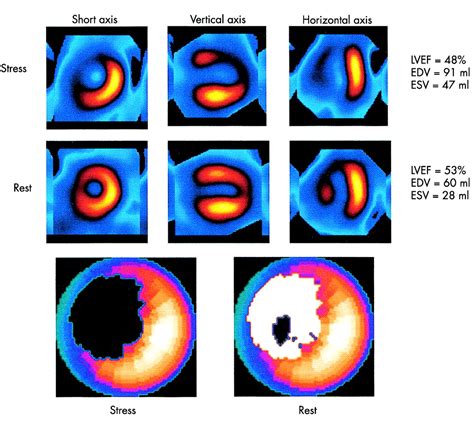 Role Of Myocardial Perfusion Imaging For Risk Stratification In