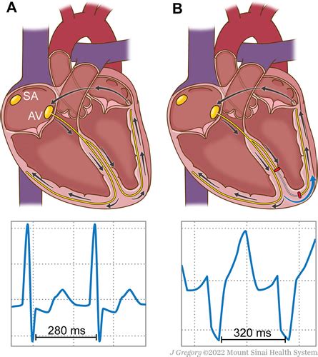 Wide Complex Tachycardia The Answer Is In Front Of You Jacc Case