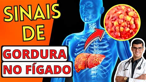 Descubra os Sinais de Gordura no Fígado ou Esteatose Hepática Fígado