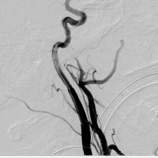 Left Internal Carotid Artery Angiogram Demonstrating Spasm At The Level