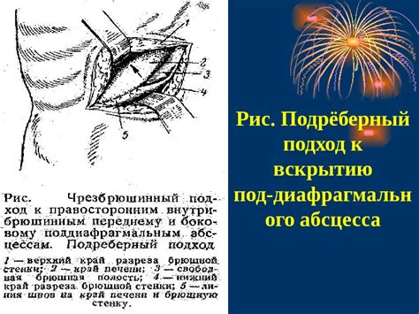 Презентация Поддиафрагмальный абсцесс
