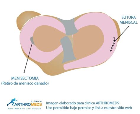 Operaci N De Lesi N De Meniscos Menisectomia Y Sutura