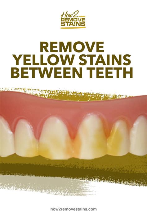 How To Remove Yellow Stains Between Teeth Remove Yellow Stains