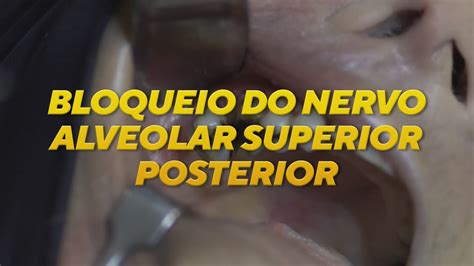 Como Realizar O Bloqueio Do Nervo Alveolar Superior Posterior YouTube