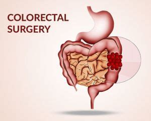 Ulcerative Colitis Surgery Know Different Options Of Tackling It