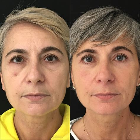 Upper Lower Blepharoplasty With Fat Transfer Before After Photos