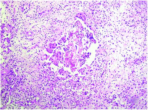 Histopathological Section From Patient Diagnosed As M Mycetomatis