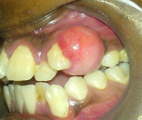 Pyogenic Granuloma Causes Symptoms Diagnosis Prognosis And Treatment