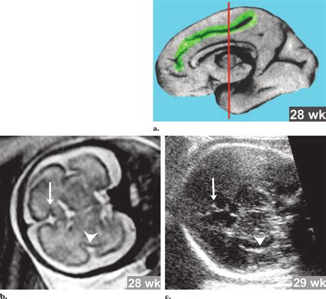 Cingulate Sulcus