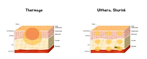 Thermage Vs Ultherapy Which One Is Right For You Jivaka Beauty