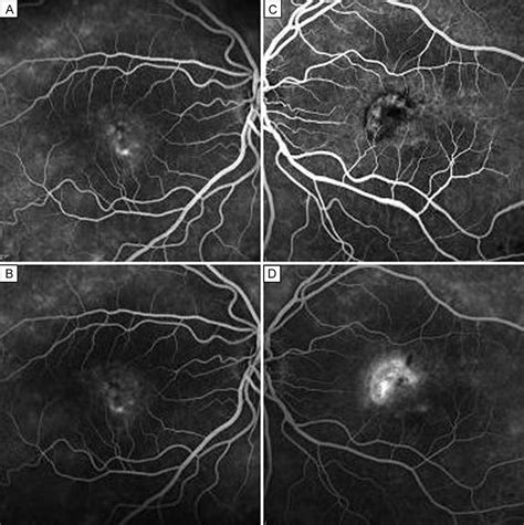 Cystoid Macular Edema Fluorescein Angiography