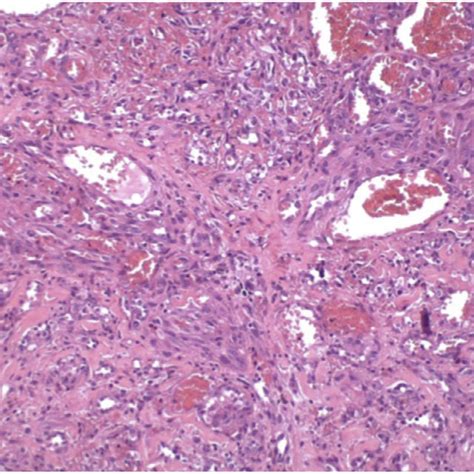 Proliferation Of Epithelioid And Spindle Cells Permeating Malformed