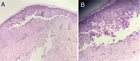 Histopathology Of Skin Biopsy A At Low Power Intraepidermal