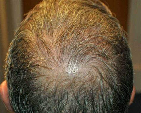 How Much Does A Crown Hair Transplant Cost