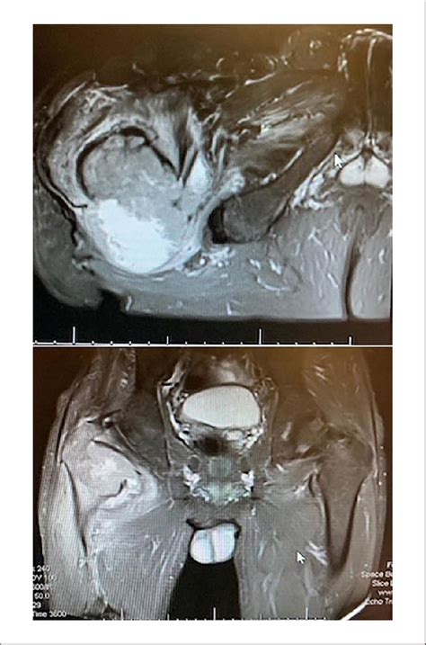 Right Hip Magnetic Resonance Imaging Mri Demonstrated An Aggressive