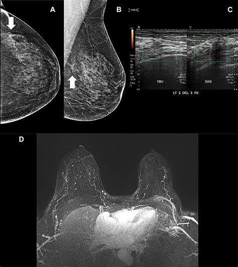 Whats Hot In Breast MRI Anabel M Scaranelo 2022