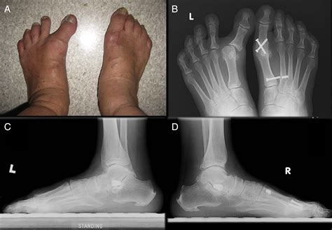 Spontaneous Subtalar Fusion An Irreversible Complication Of Subtalar