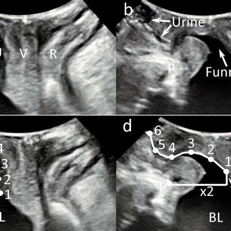 Transperineal Ultrasound Images In The Mid Sagittal Plane During