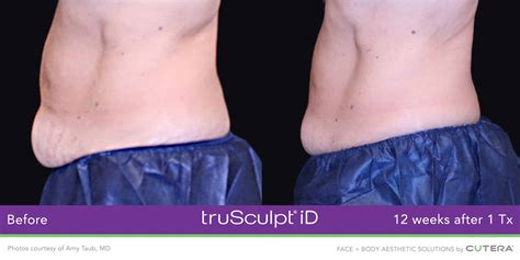 The Top 5 Benefits Of Trusculpt® Id Carnegie Womens Health