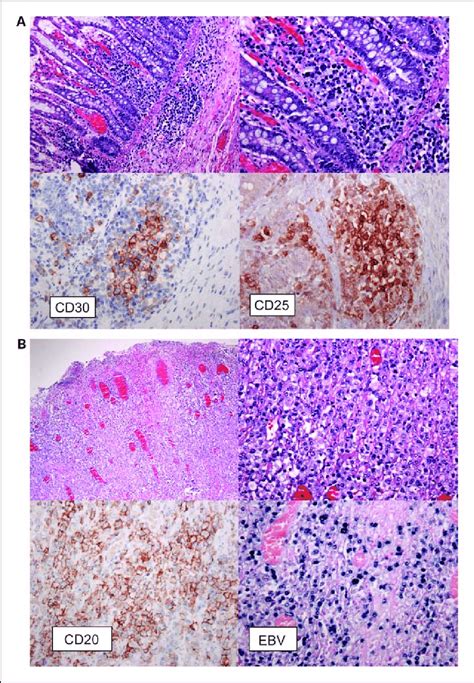 Histologic Examination Of Colonic Biopsy In 58 Year Old Asian Female Download Scientific