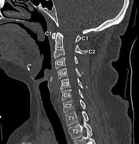 Head And Spine Anatomy Radiology Cafe