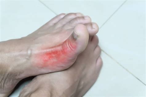 How Gout Affects Your Feet - The Foot Care Group