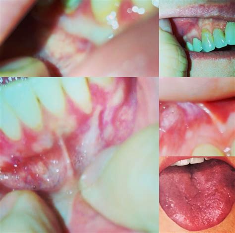 List 90 Pictures Pictures Of Oral Lichen Planus Sharp