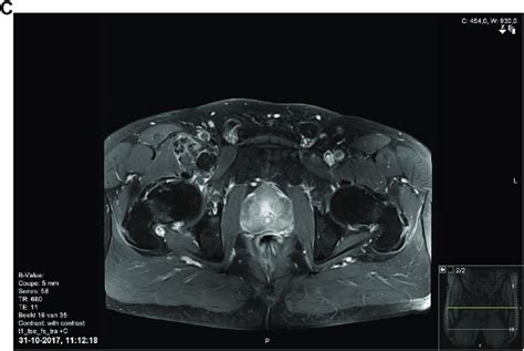 c. Communication of the lesion with the hip joint in MRI. MRI image ...