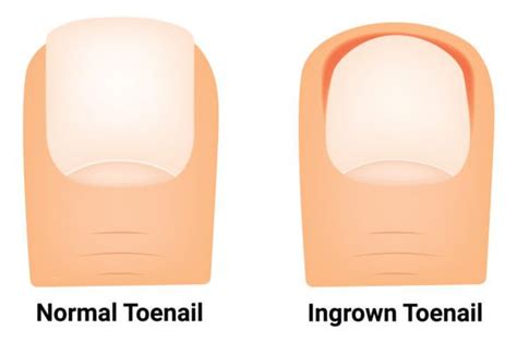Normal Toenail and Ingrown Toenail Graphic by hamjaiu · Creative Fabrica