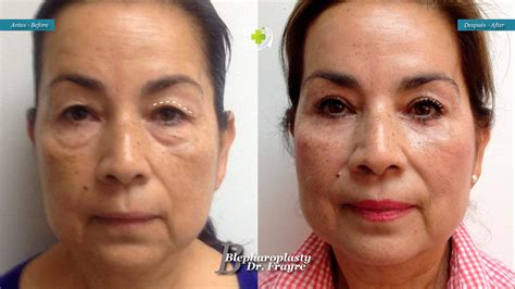 Facials Surgery Cosmetic Surgery In M Xico Cosmetic Surgery M Xico