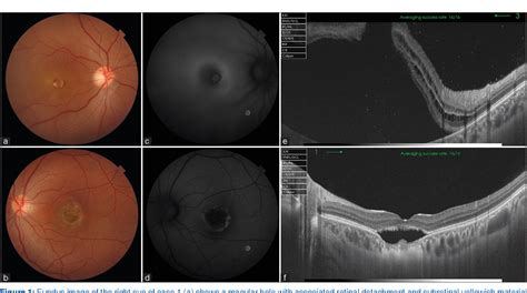 Figure 1 From Macular Hole Associated Retinal Detachment In Best Vitelliform Dystrophy Series