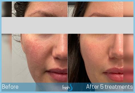 Laser Photo Facial Nw Calgary Fresh Laser Skin Studio