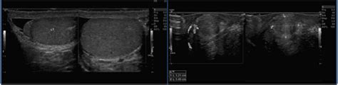 Scrotal Ultrasound Showed A Rounded Heterogenous Mass At The Tail Of