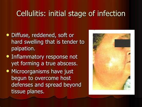 Spread Of Oral Infections