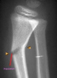 Greenstick Fracture - Treatment, Symptoms, Causes, Diagnosis, Pictures