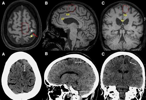 Supplementary Motor Area Mri